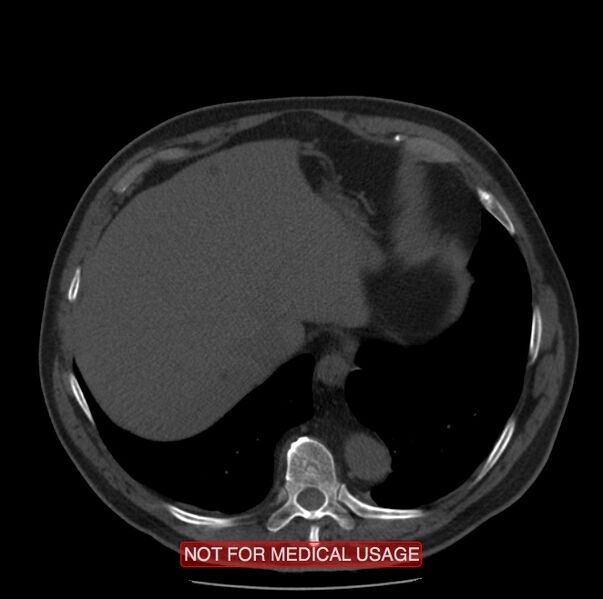 File:Acute aortic dissection - Stanford type A (Radiopaedia 40661-43285 Axial non-contrast 61).jpg