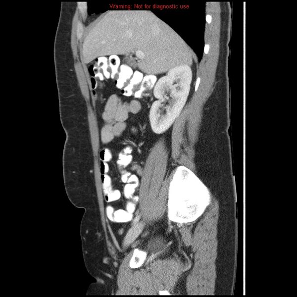 File:Acute appendicitis (Radiopaedia 7966-8812 B 5).jpg