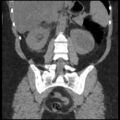 Acute cholecystitis and ureteric colic (Radiopaedia 42330-45444 Coronal prone 69).jpg