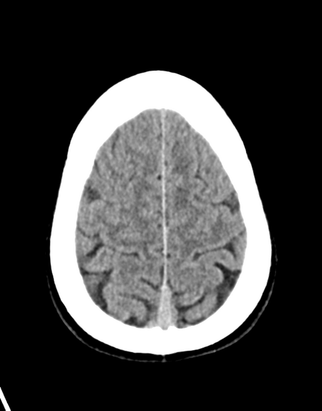 File:Acute disseminated encephalomyelitis (ADEM) (Radiopaedia 65319-74348 Axial non-contrast 27).png