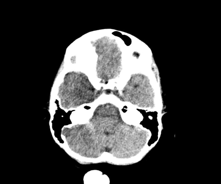 File:Acute epidural hematoma (Radiopaedia 63659-72335 Axial non-contrast 2).jpg