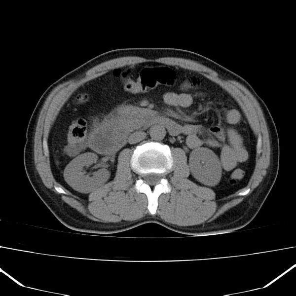 File:Acute pancreatitis (Radiopaedia 22572-22596 Axial non-contrast 29).jpg