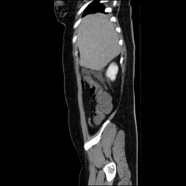 File:Acute pancreatitis (Radiopaedia 69236-79012 Sagittal C+ portal venous phase 80).jpg