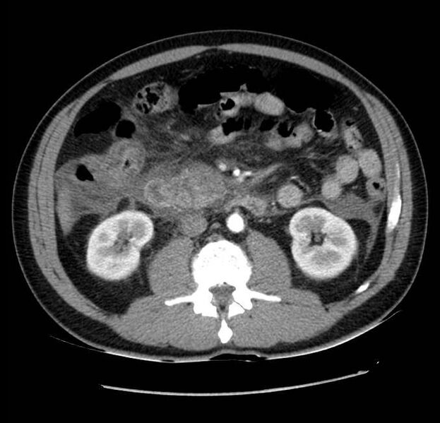 File:Acute pancreatitis - Balthazar E (Radiopaedia 23080-23110 Axial C+ arterial phase 33).jpg
