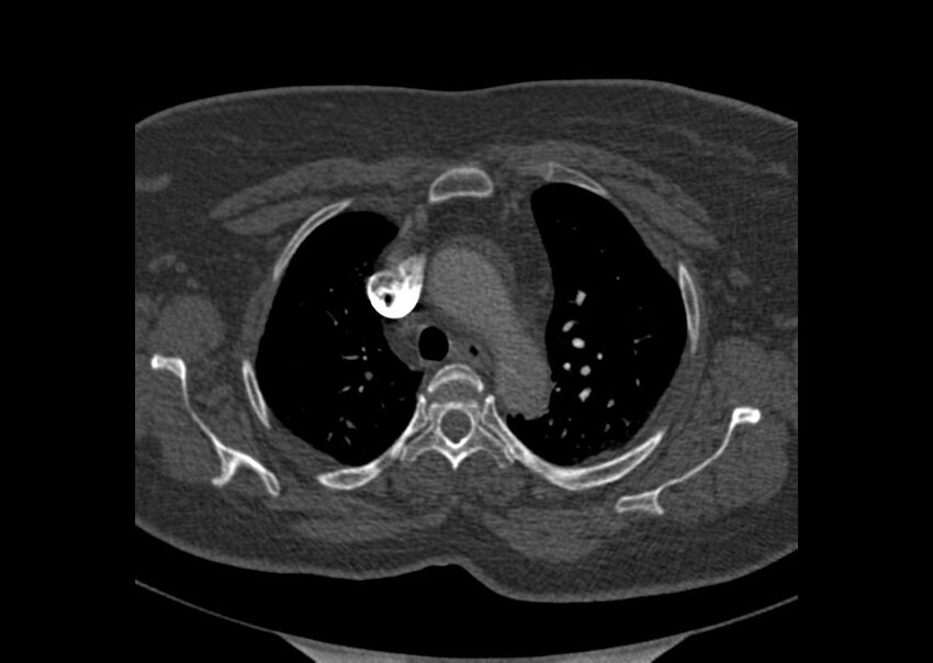 Acute pulmonary embolism (Radiopaedia 29938-30466 Axial C+ CTPA 1).jpg