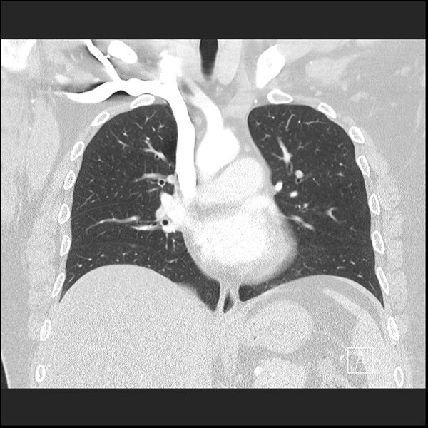 File:Acute pulmonary embolism with pulmonary infarct (Radiopaedia 73062-83768 Coronal lung window 37).jpg