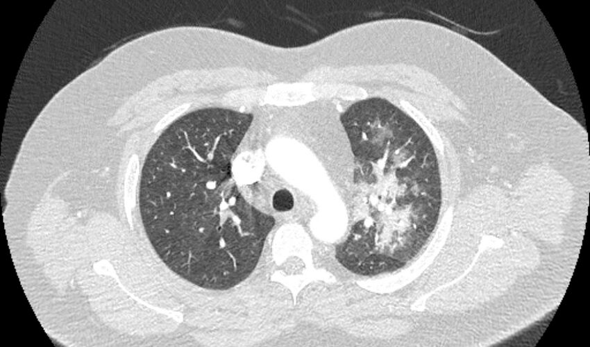 Acute pulmonary embolism with pulmonary infarcts (Radiopaedia 77688-89908 Axial lung window 27).jpg