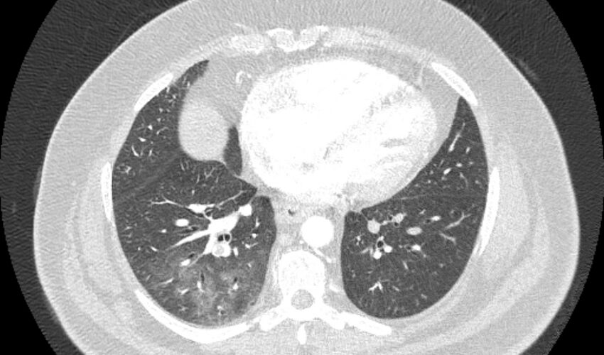 Acute pulmonary embolism with pulmonary infarcts (Radiopaedia 77688-89908 Axial lung window 83).jpg