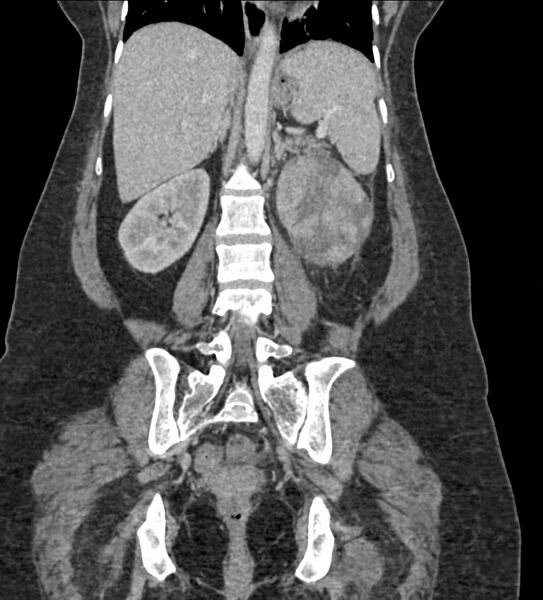 File:Acute pyelonephritis with renal vein thrombosis (Radiopaedia 58020-65053 Coronal renal parenchymal phase 73).jpg