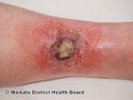 Acute radiation dermatitis (DermNet NZ reactions-w-radiation-dermatitis2).jpg
