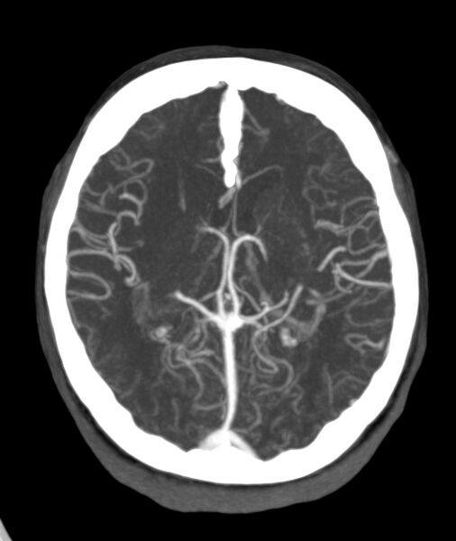 File:Acute right MCA M1 occlusion (Radiopaedia 62268-70454 Axial Phase 2 14).jpg