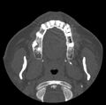 Acute sinusitis (Radiopaedia 23161-23215 Axial bone window 20).jpg