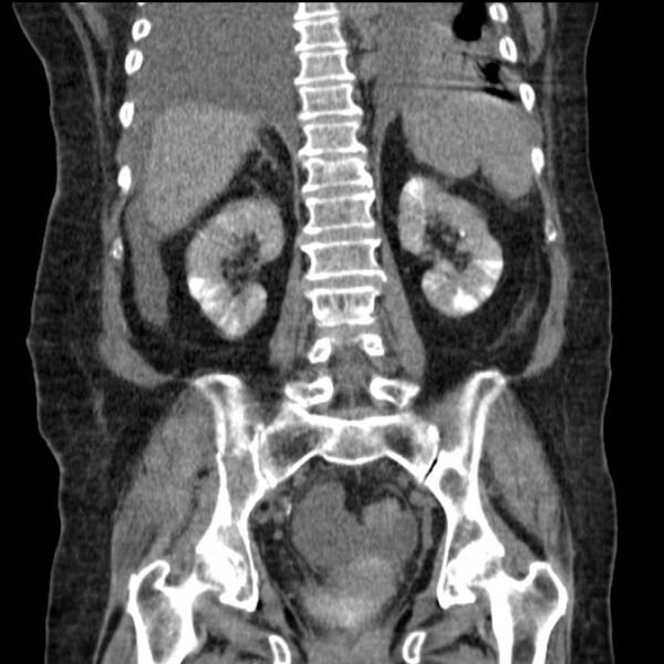 File:Acute tubular necrosis (Radiopaedia 28077-28334 D 58).jpg