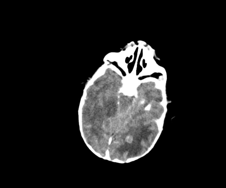 File:Acute ventriculitis (Radiopaedia 57502-64459 Axial +contrast 6).jpg