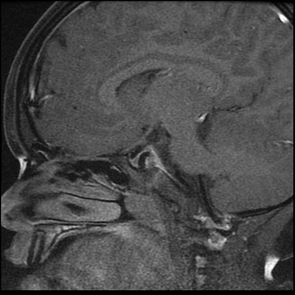 File:Adamantinomatous craniopharyngioma (Radiopaedia 77407-89529 Sagittal T1 C+ fat sat 11).jpg