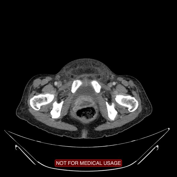 File:Adenocarcinoma of the cervix (Radiopaedia 28373-28616 Axial C+ portal venous phase 25).jpg