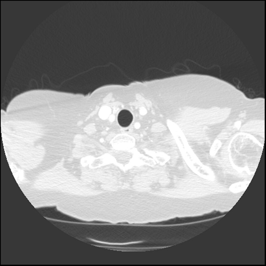 Adenocarcinoma of the lung (Radiopaedia 41015-43755 Axial lung window 4).jpg