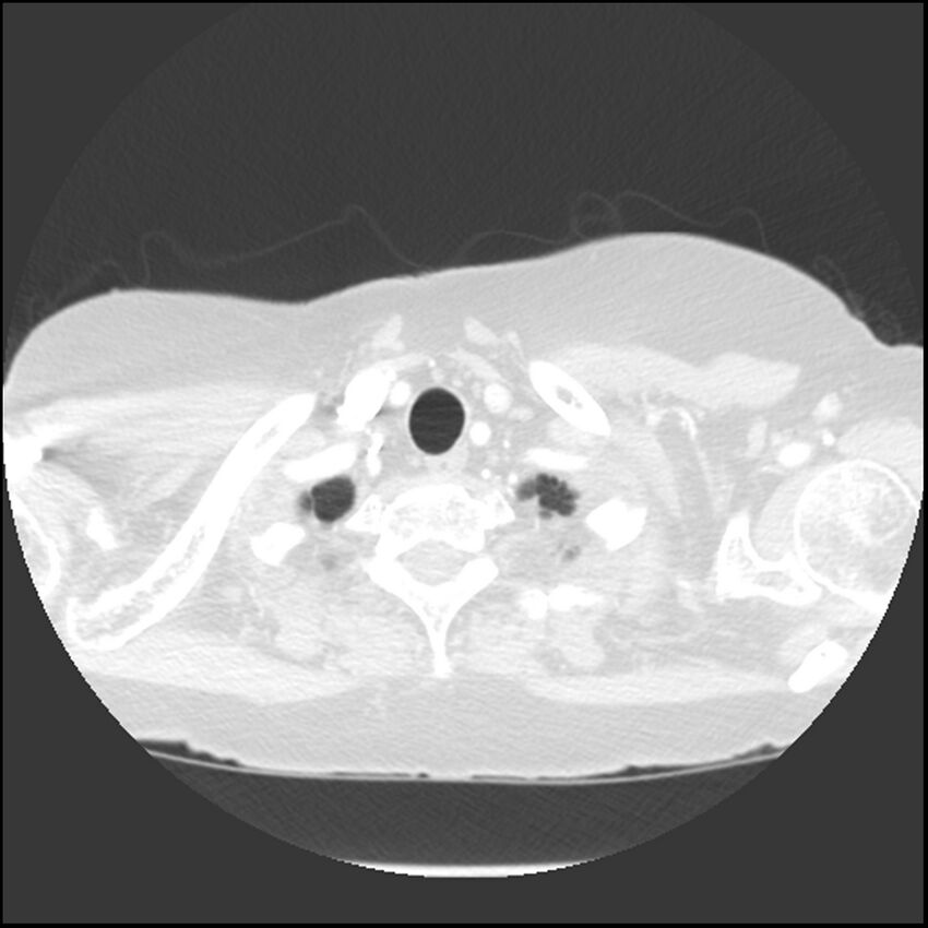 Adenocarcinoma of the lung (Radiopaedia 41015-43755 Axial lung window 8).jpg