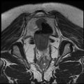 Adenoma malignum of the cervix (Radiopaedia 24460-24765 Coronal T2 26).jpg