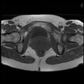 Adenoma malignum of the cervix (Radiopaedia 24460-24765 T1 16).jpg