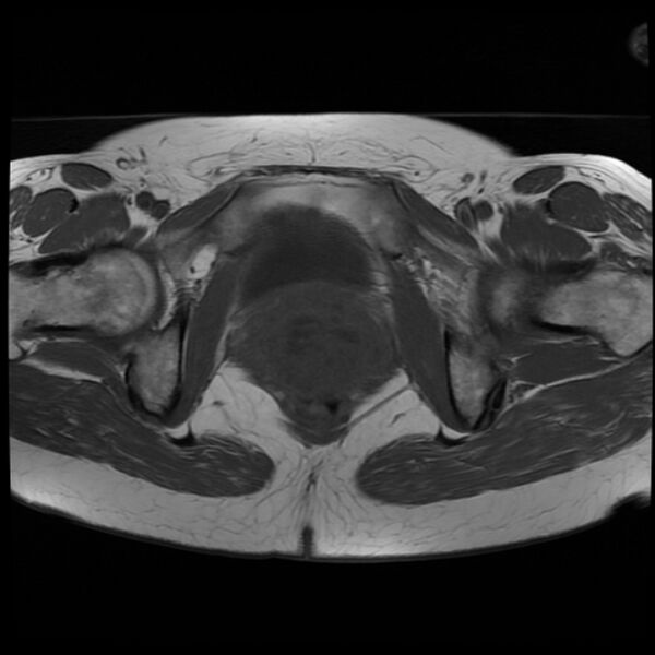 File:Adenoma malignum of the cervix (Radiopaedia 24460-24765 T1 16).jpg
