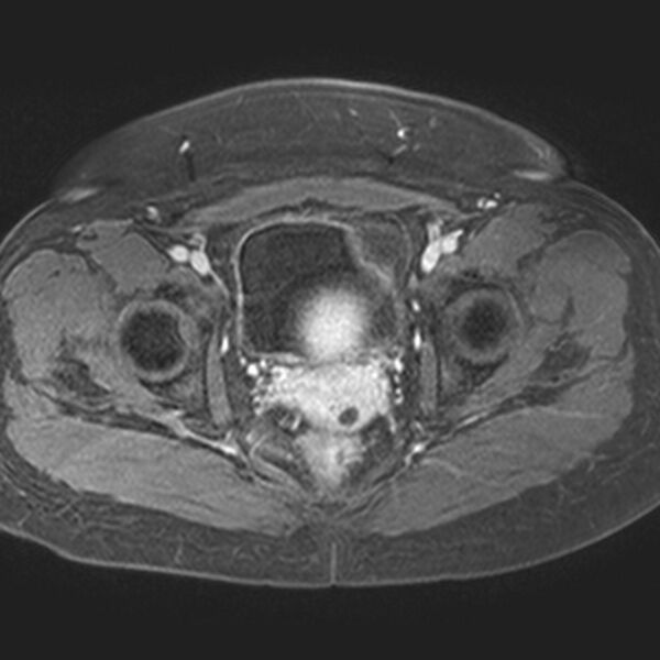File:Adenomyoma of the uterus (Radiopaedia 9871-10439 Axial T1 C+ fat sat 8).jpg