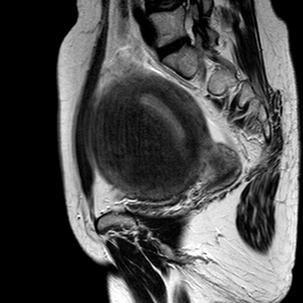 File:Adenomyoma of the uterus (huge) (Radiopaedia 9870-10438 Sagittal T2 5).jpg