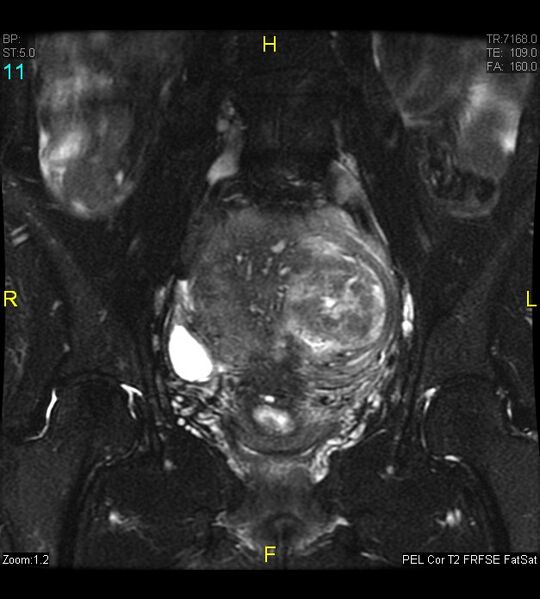 File:Adenomyosis (Radiopaedia 43504-46889 Coronal T2 fat sat 11).jpg