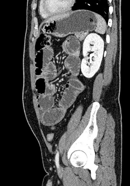 File:Adhesional small bowel obstruction (Radiopaedia 58900-66131 Sagittal C+ portal venous phase 181).jpg