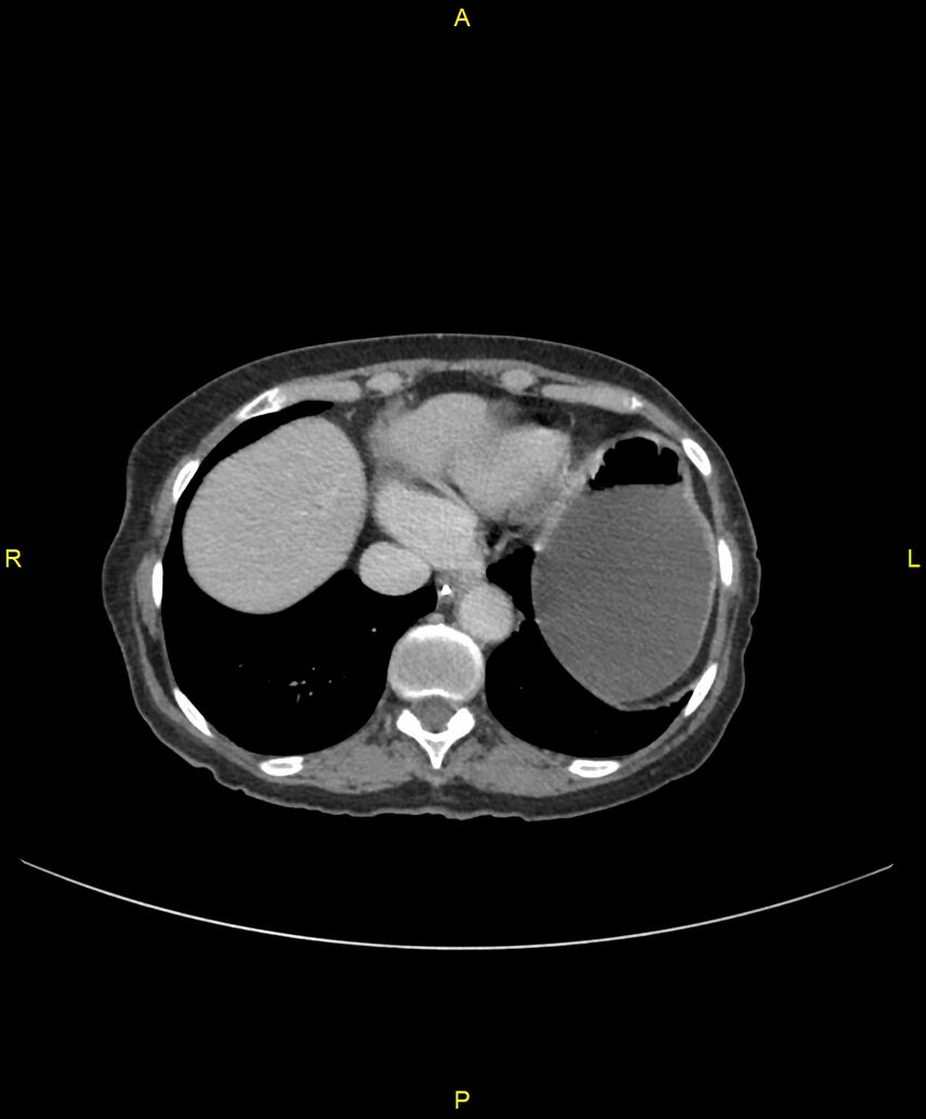 Adhesional small bowel obstruction (Radiopaedia 85402-101024 Axial C+ portal venous phase 30).jpg