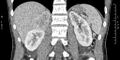 Adrenal pheochromocytoma (Radiopaedia 35133-36726 Coronal C+ portal venous phase 22).jpg