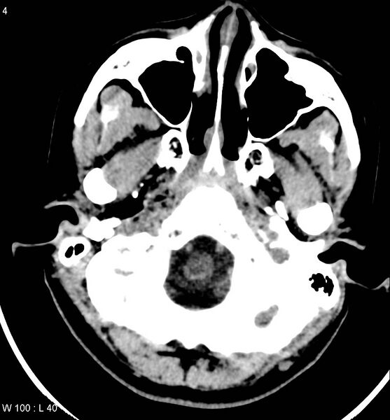 File:Aicardi syndrome (Radiopaedia 5353-7116 Axial non-contrast 1).jpg