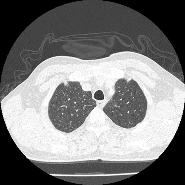 File:Airway foreign body in adult (Radiopaedia 85907-101779 Axial lung window 17).jpg