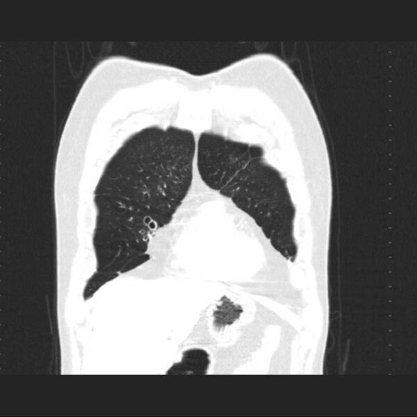 File:Allergic bronchopulmonary aspergillosis (Radiopaedia 21386-21320 Coronal lung window 3).jpg