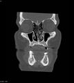 Ameloblastoma (Radiopaedia 18115-17901 Axial bone window 20).jpg