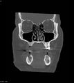 Ameloblastoma (Radiopaedia 18115-17901 Axial bone window 24).jpg