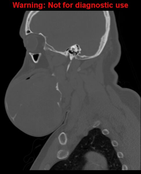 File:Ameloblastoma (Radiopaedia 33126-34164 Sagittal bone window 27).jpg