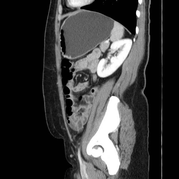 File:Ampullary tumor (Radiopaedia 22787-22816 D 40).jpg