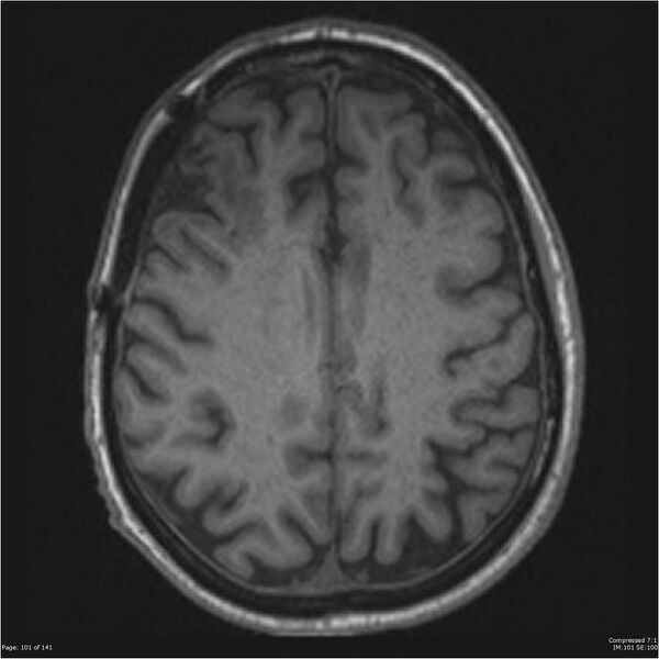 File:Anaplastic meningioma with recurrence (Radiopaedia 34452-35788 Axial T1 99).jpg