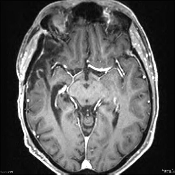 File:Anaplastic meningioma with recurrence (Radiopaedia 34452-35788 Axial T1 C+ 62).jpg