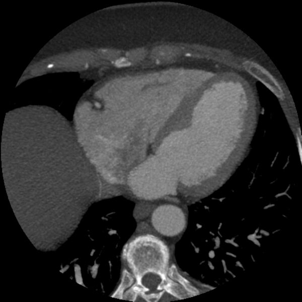 File:Anomalous origin of left circumflex artery from right coronary sinus (Radiopaedia 72563-83117 A 20).jpg