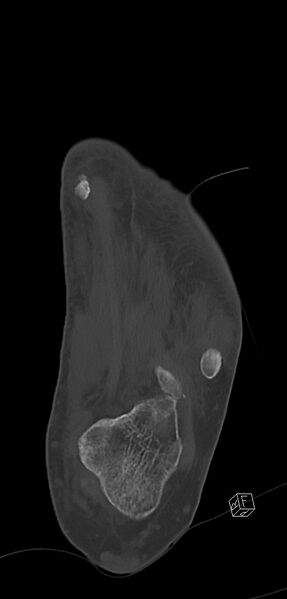 File:Anterior calcaneal process fracture (Radiopaedia 63353-71943 Coronal bone window 34).jpg