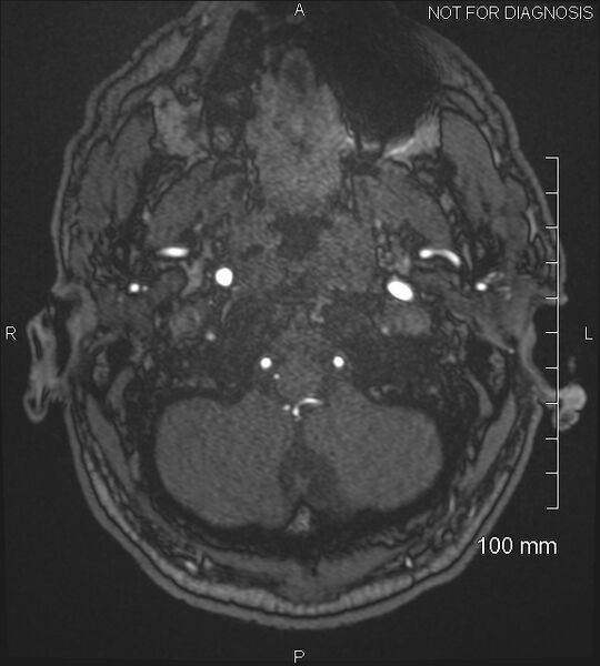 File:Anterior cerebral artery aneurysm (Radiopaedia 80683-94127 Axial MRA 12).jpg