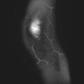 Anterior cruciate ligament tear - pediatric (Radiopaedia 62152-70260 Sagittal PD fat sat 33).jpg