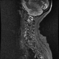 Anterior spinal artery syndrome (Radiopaedia 46335-50750 Sagittal STIR 2).png