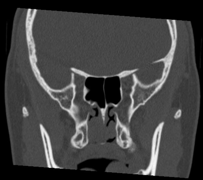 File:Antrochoanal polyp (Radiopaedia 21894-21868 Coronal bone window 23).jpg