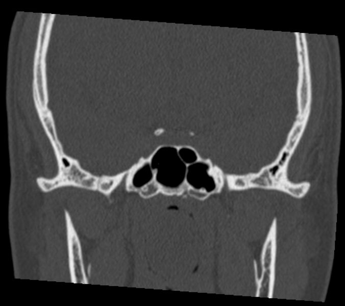 File:Antrochoanal polyp (Radiopaedia 21894-21868 Coronal bone window 31).jpg