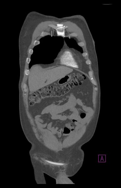 File:Aortectomy and axillary-bifemoral bypass (Radiopaedia 28303-28545 C 20).jpg