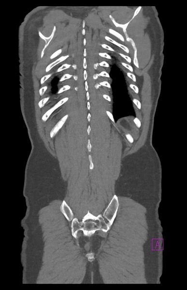 File:Aortectomy and axillary-bifemoral bypass (Radiopaedia 28303-28545 C 81).jpg