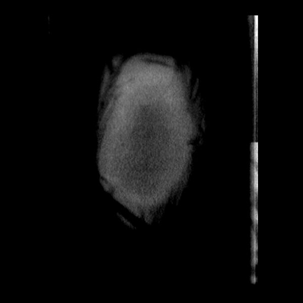 File:Aortic arch graft infection (FDG PET-CT) (Radiopaedia 71975-82437 Coronal 61).jpg